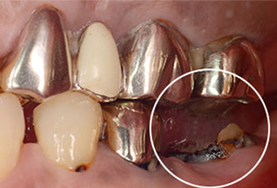 歯冠長延長術-治療前