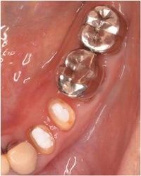 歯冠長延長術症例02-治療後