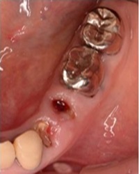 歯肉弁根尖側移動術症例02-治療前