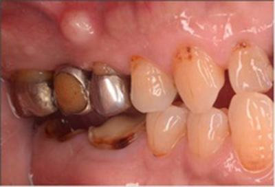 歯冠長延長術症例03-治療前