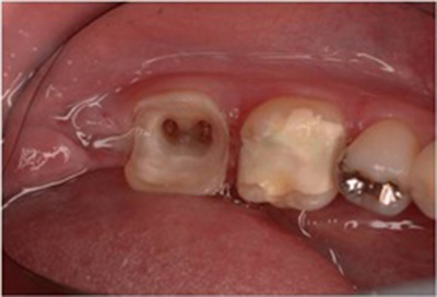 歯肉弁根尖側移動術症例04-治療後
