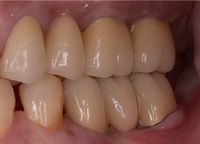 歯肉弁根尖側移動術症例05-治療5