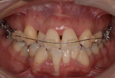 結合組織移植術症例03-矯正治療開始から半年後