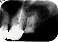 根管治療症例07-治療後