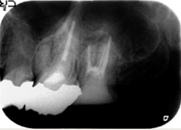 根管治療症例07-治療後