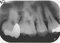 根管治療症例09-治療前