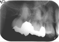 根管治療症例09-治療後