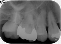 根管治療症例09-治療後