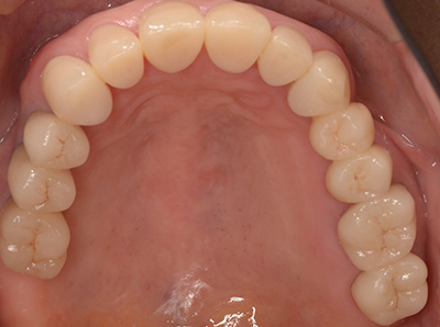 インプラント症例01-上顎-治療後