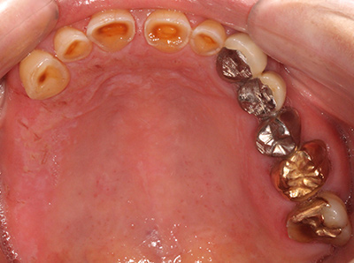 インプラント症例01-上顎-治療前