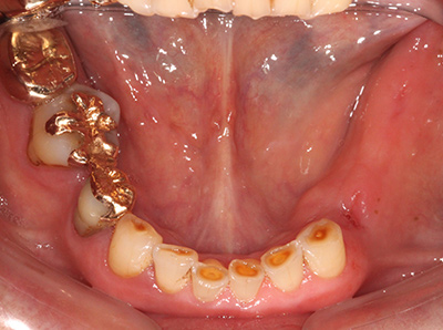 インプラント症例01-下顎-治療前