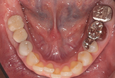 インプラント症例04-治療後