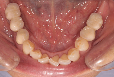インプラント症例05-治療後