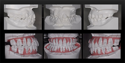 矯正治療・噛み合わせ治療症例06-術前と術後のシミュレーション