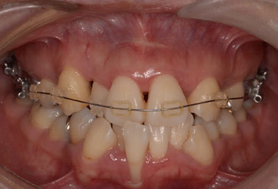 矯正治療・噛み合わせ治療症例06-矯正治療開始から半年後