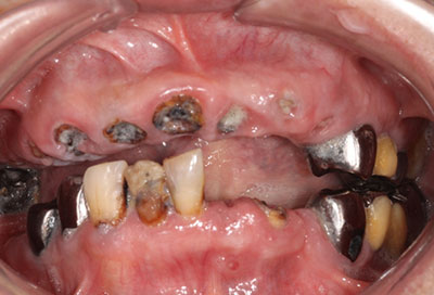 歯周病治療症例01-治療前