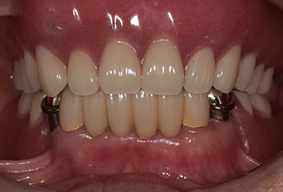 歯周病治療症例02-治療後