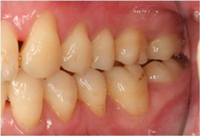 歯周病治療症例05-治療後