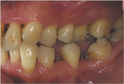 歯周病治療症例05-治療前
