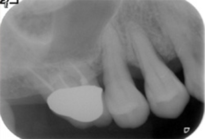 歯周組織再生療法症例02-治療後