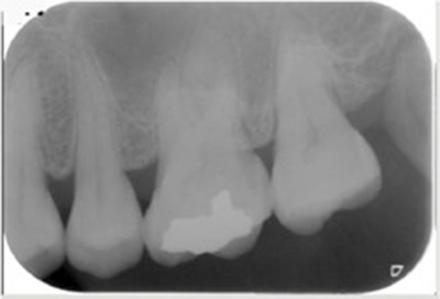 歯周組織再生療法症例04-治療後