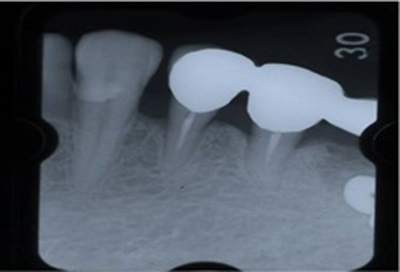 歯周組織再生療法症例05-治療後