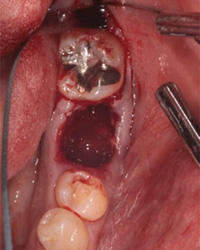 歯牙移植症例01-治療2