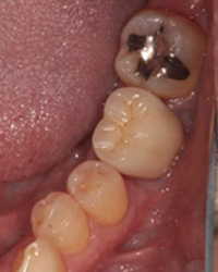 歯牙移植症例01-治療3