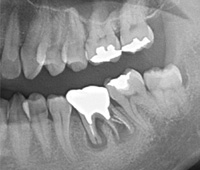 歯牙移植症例01-治療4