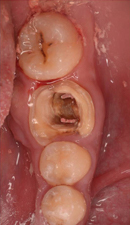歯牙移植症例02-治療1