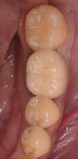 歯牙移植症例02-治療3