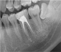 歯牙移植症例02-治療4