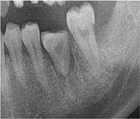 歯牙移植症例02-治療5