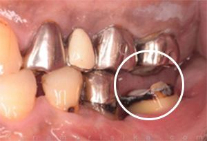 歯肉弁根尖足移動術症例01-治療前