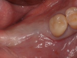 離歯肉移植術症例01-治療前