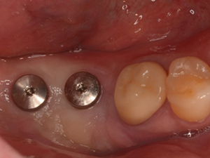 離歯肉移植術症例01-治療後