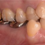 歯並びが悪く，よく噛めない　歯列矯正＋歯肉弁根尖側移動術　