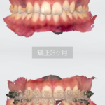 ～歯科衛生士の矯正記録～
