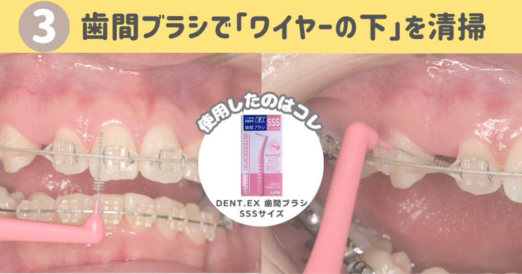 北品川　歯医者　矯正