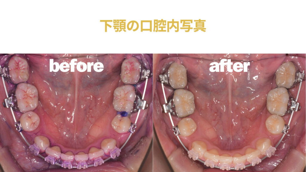 歯医者　矯正　クリーニング