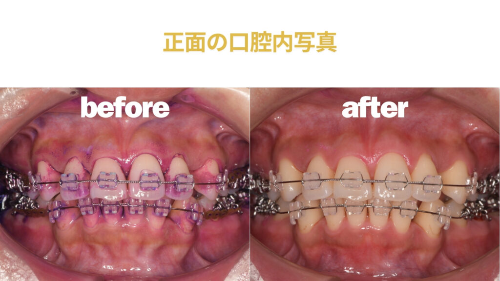 歯医者　矯正　クリーニング