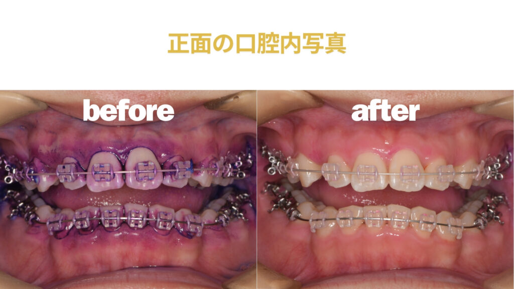 歯医者　矯正　クリーニング