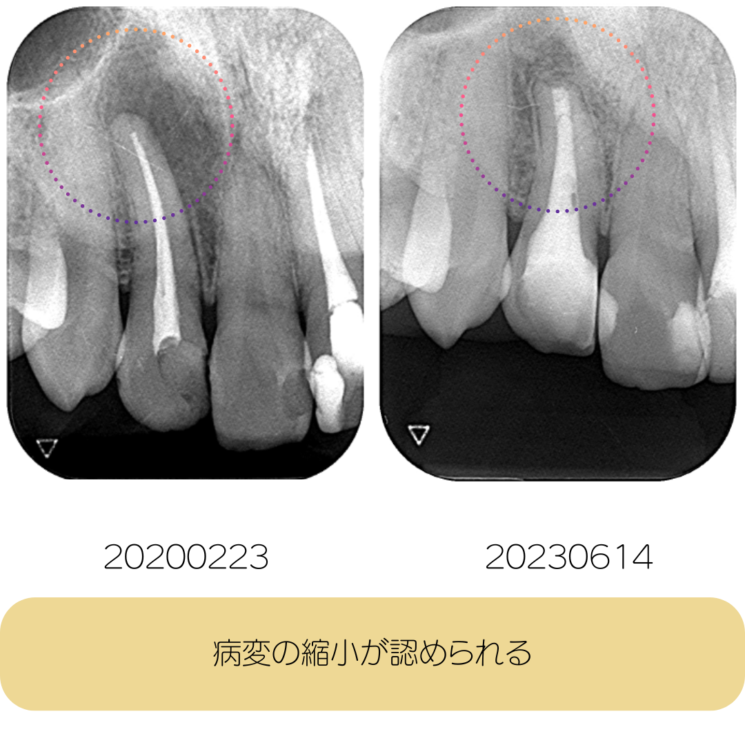 根管治療症例00