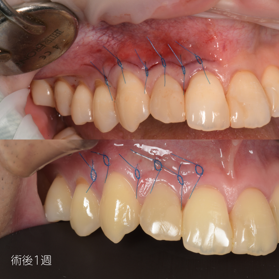 根管治療症例00