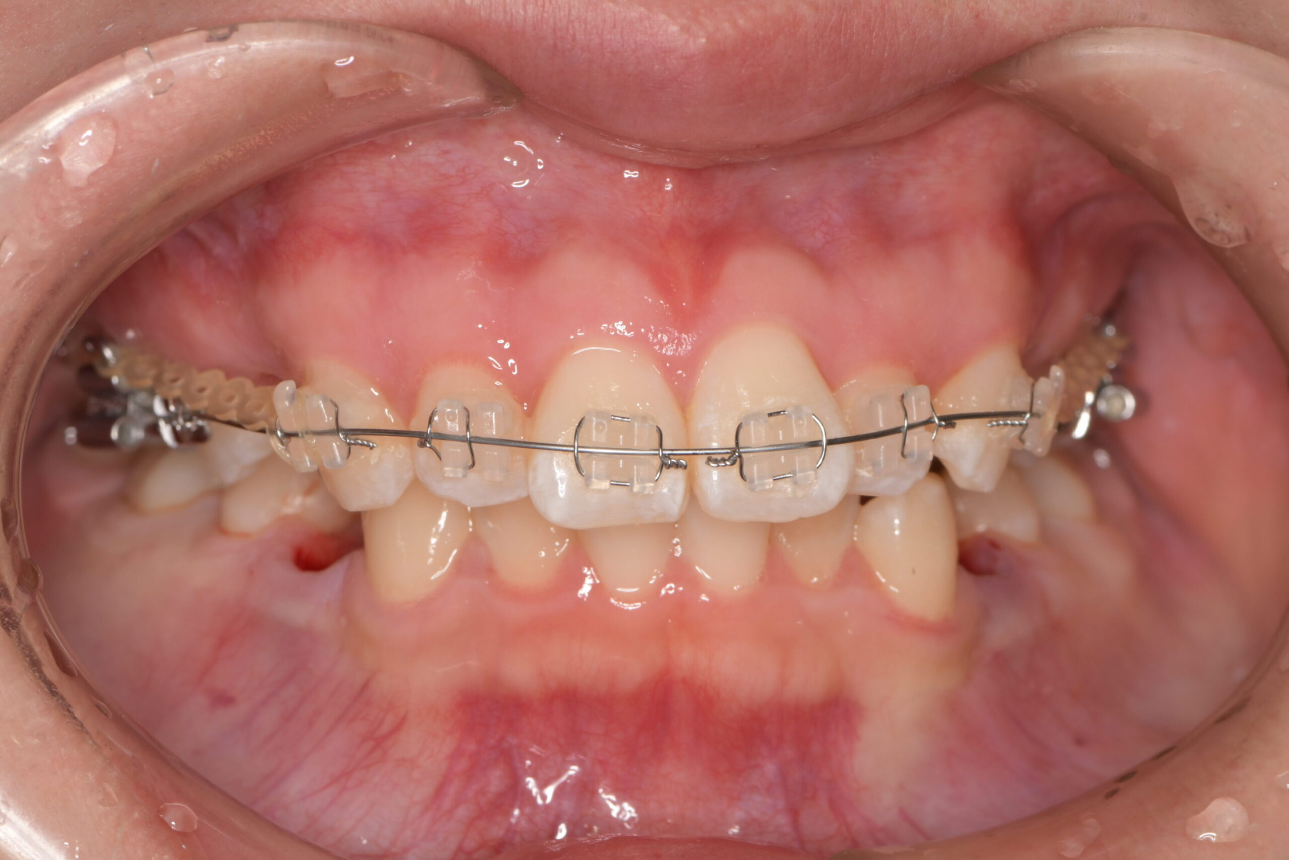 矯正治療中の歯並び