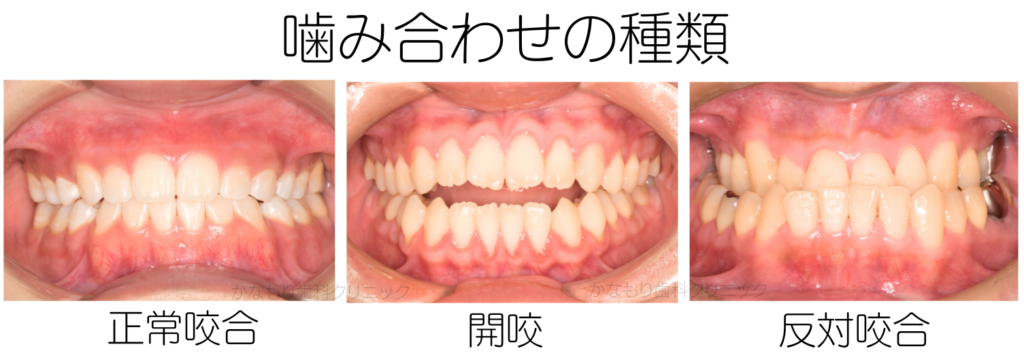 噛み合わせの種類