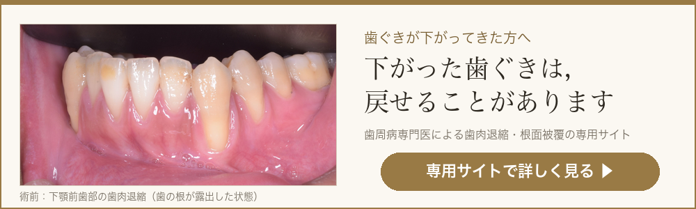 歯肉退縮治療