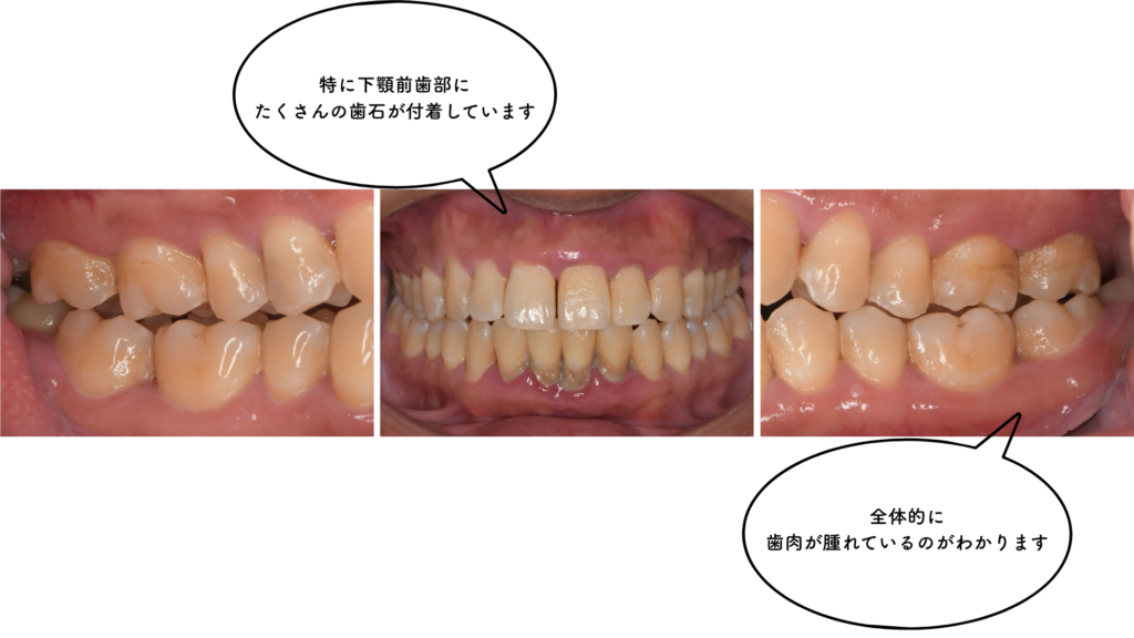 30代の歯周病