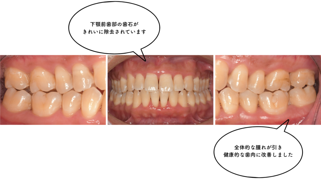 30代の歯周病