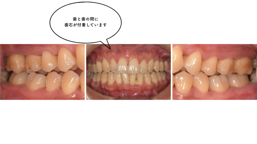 40代の歯周病